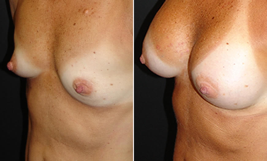 Before & After Breast Augmentation Quarter Left View