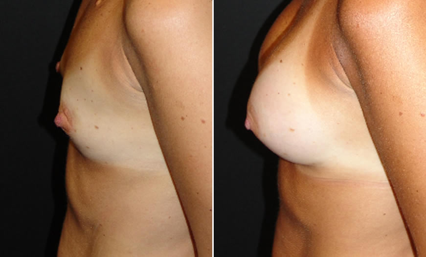 Before & After Breast Augmentation Side Left View