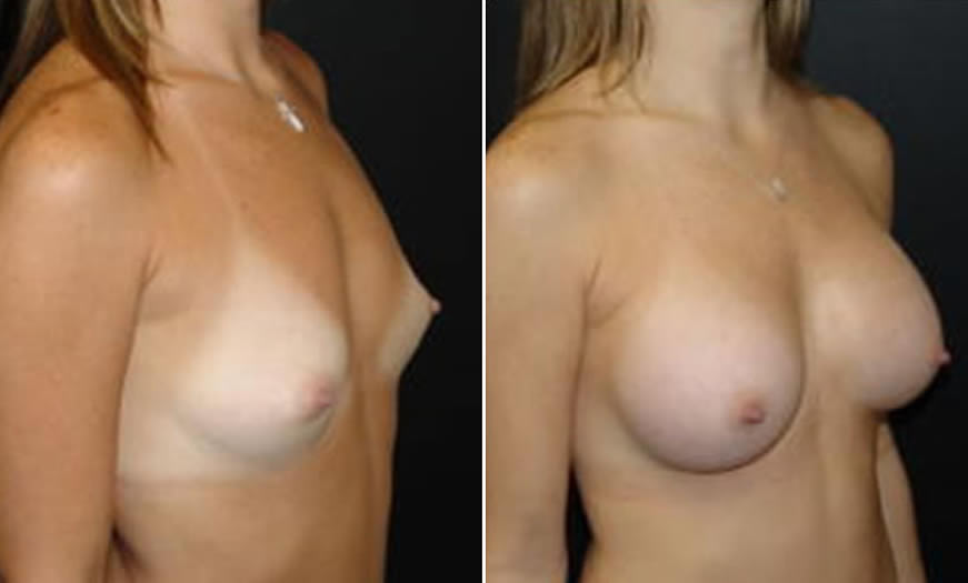 Before & After Breast Augmentation Quarter Right View