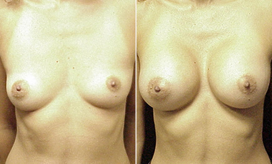 Before & After Breast Augmentation Front View