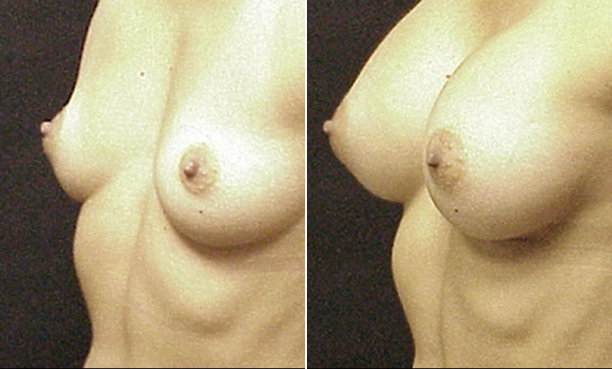 Before & After Breast Augmentation Quarter Left View