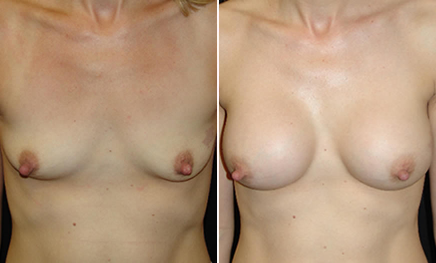 Before & After Breast Augmentation Front View