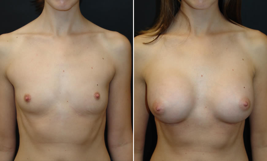 Before & After Breast Augmentation Front View