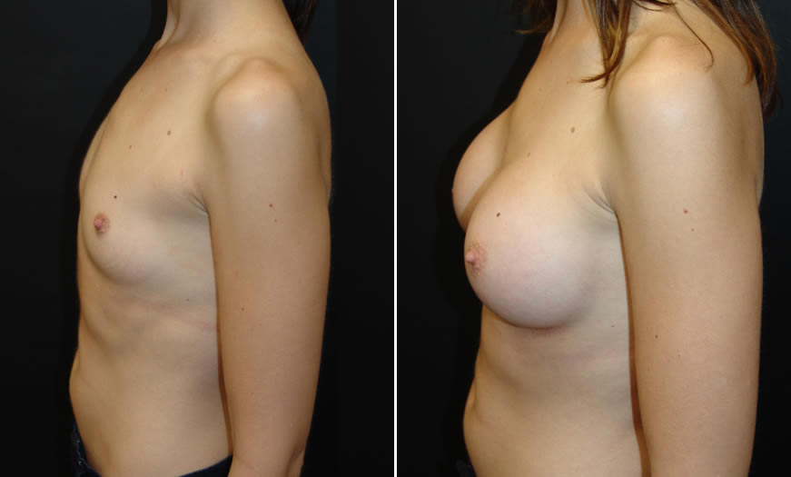 Before & After Breast Augmentation Side Left View