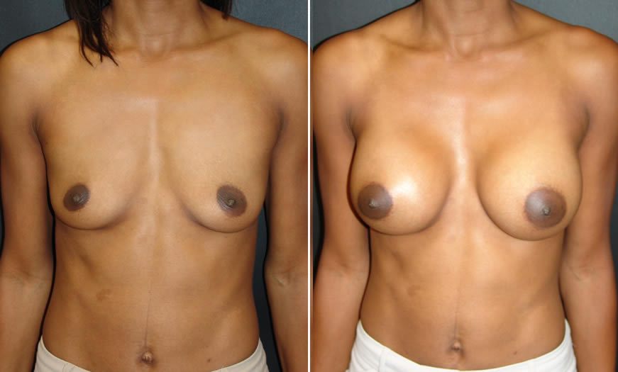 Before & After Breast Augmentation Front View