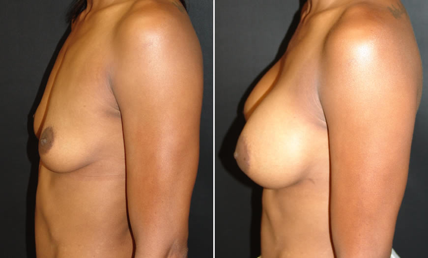 Before & After Breast Augmentation Side Left View