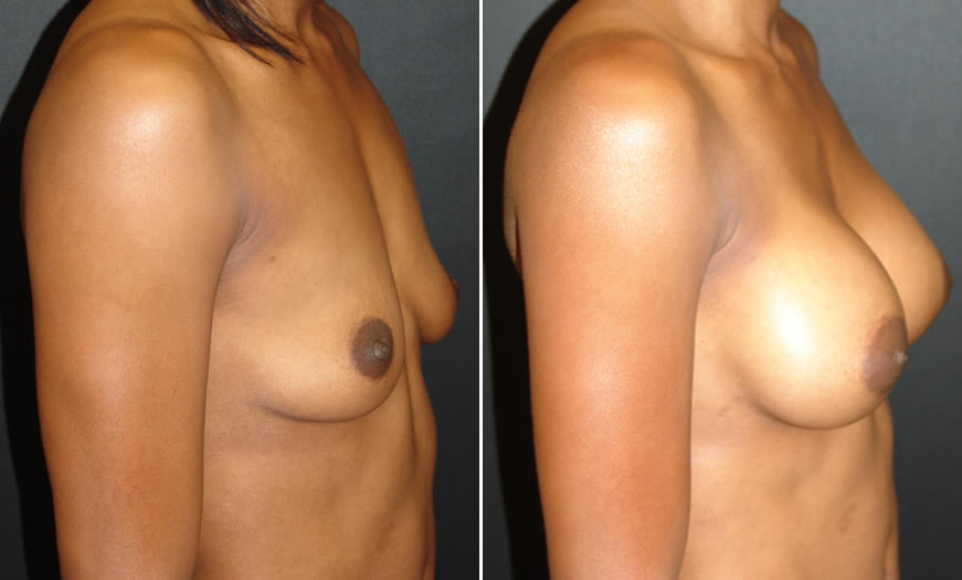 Before & After Breast Augmentation Side Right View