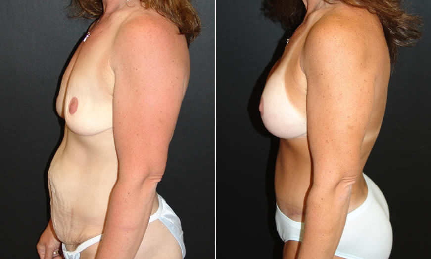 Before & After Breast Augmentation Side Left View