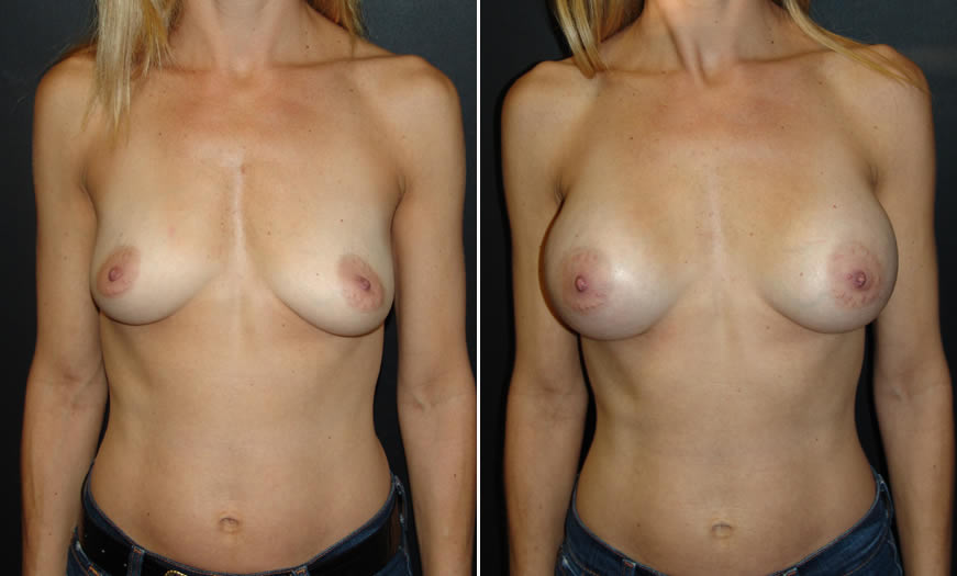 Before & After Breast Augmentation Front View