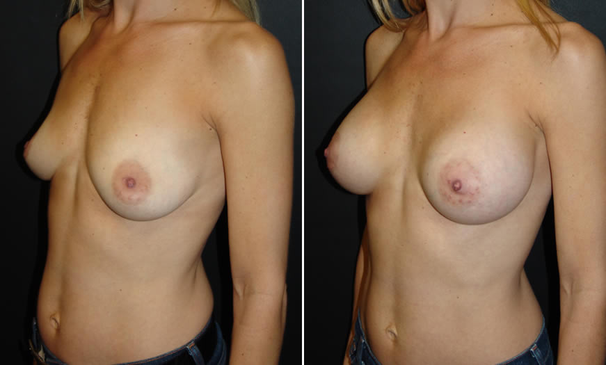 Before & After Breast Augmentation Quarter Left View