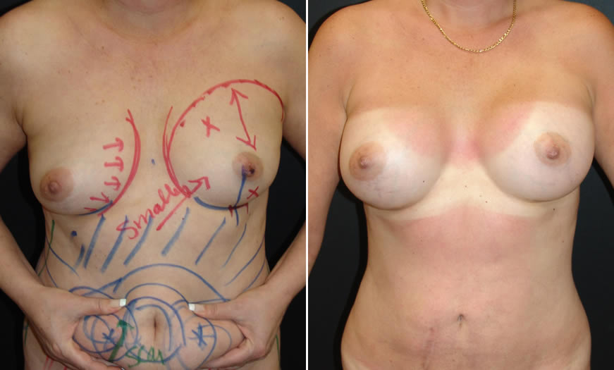 Before & After Breast Augmentation Front View