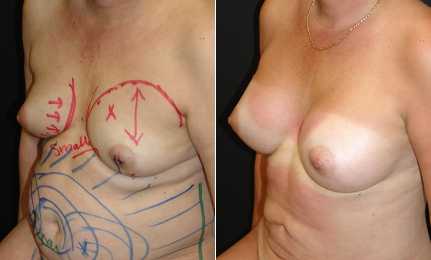 Before & After Breast Augmentation Quarter Left View