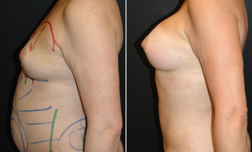 Before & After Breast Augmentation Side Left View