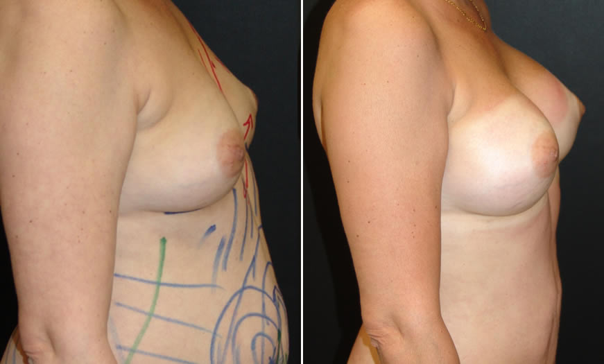 Before & After Breast Augmentation Side Right View