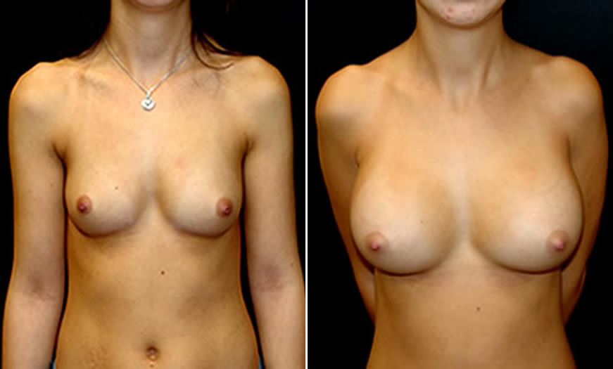 Before & After Breast Augmentation Front View