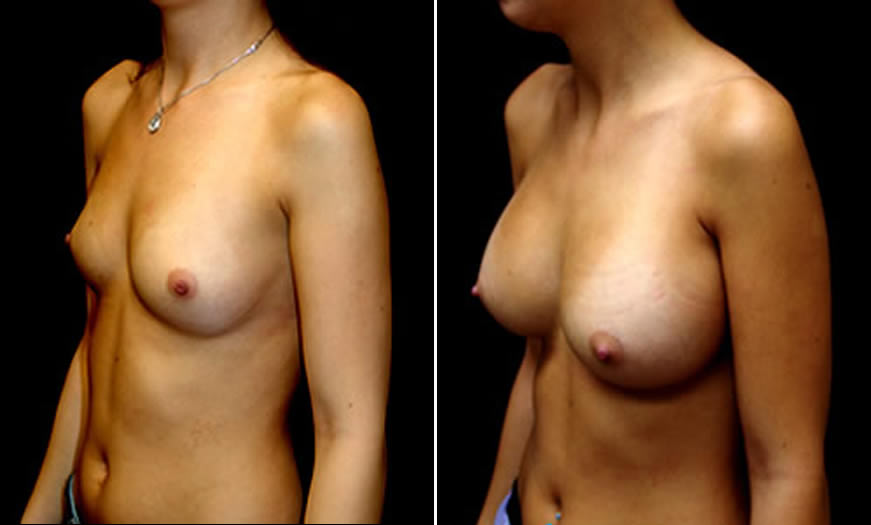 Before & After Breast Augmentation Quarter Left View