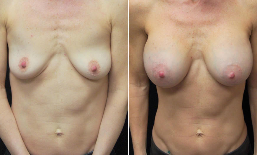 Before & After Breast Augmentation Front View