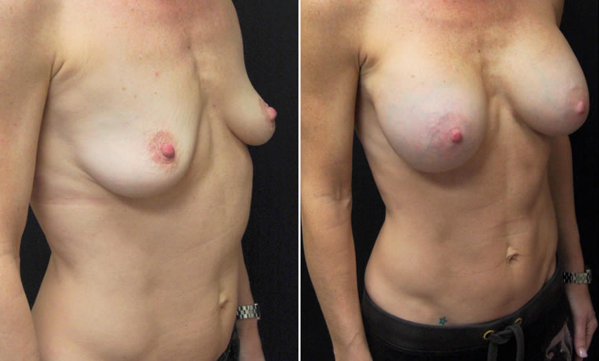 Before & After Breast Augmentation Quarter Right View