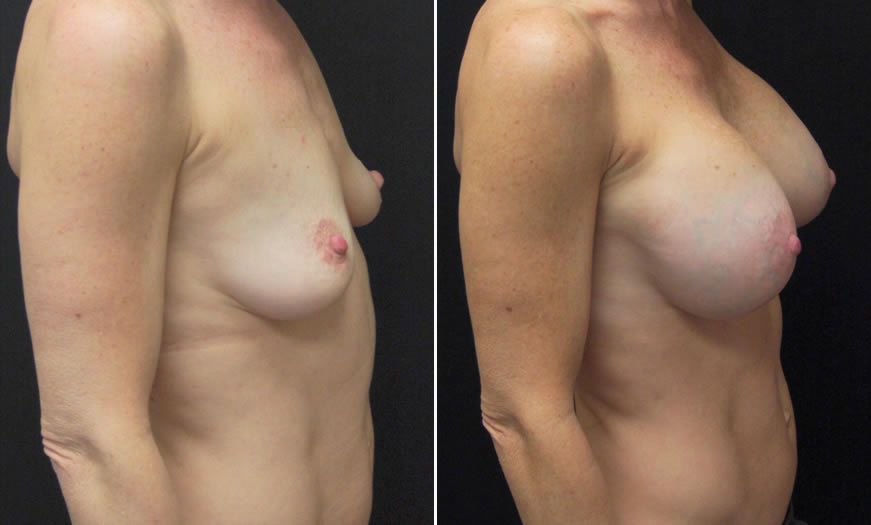 Before & After Breast Augmentation Side Right View