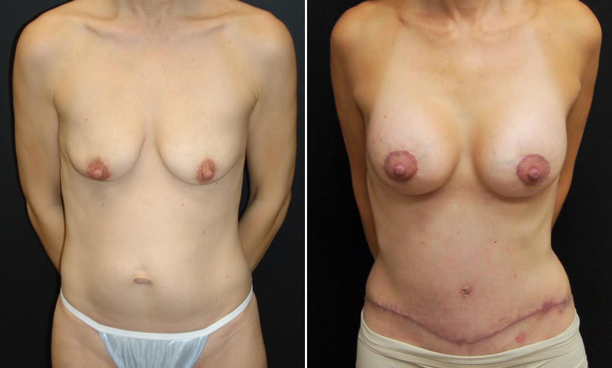 Before & After Breast Augmentation Front View