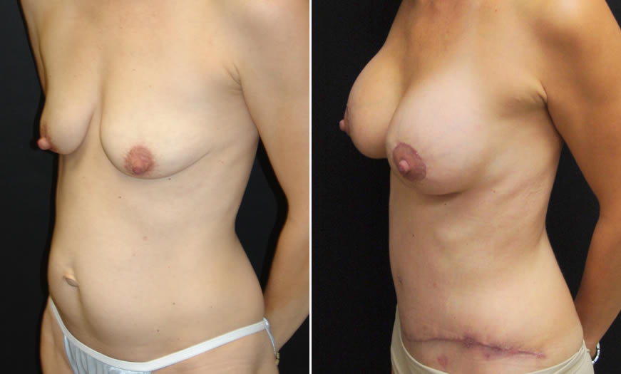 Before & After Breast Augmentation Quarter Left View