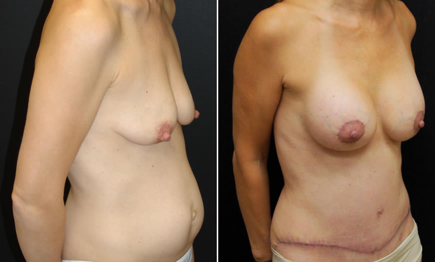 Before & After Breast Augmentation Quarter Right View