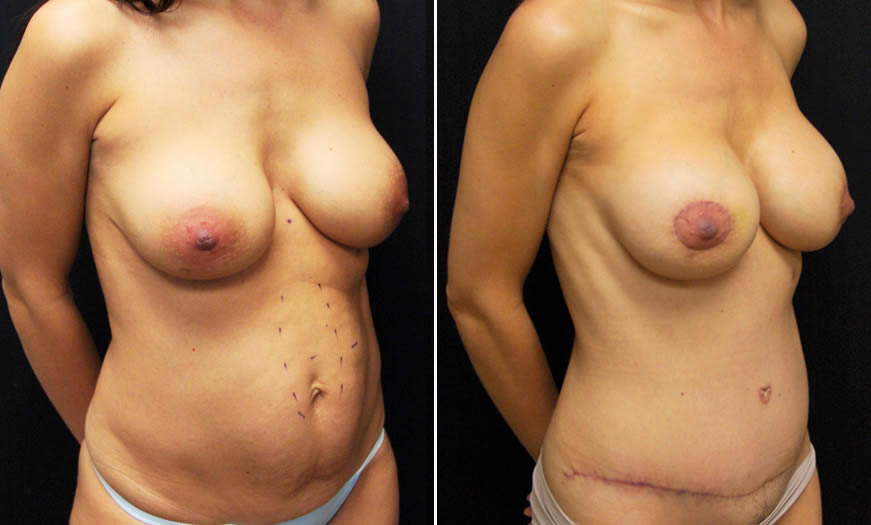 Before & After Breast Augmentation Quarter Right View