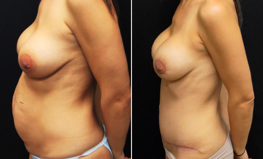 Before & After Breast Augmentation Side Left View