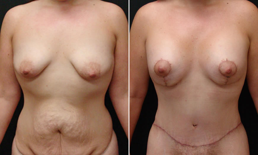 Before & After Breast Augmentation Front View