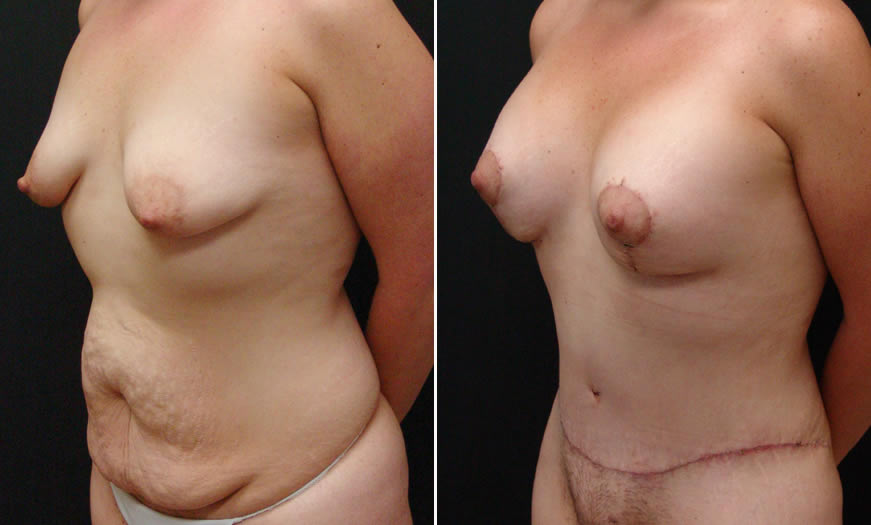 Before & After Breast Augmentation Quarter Left View