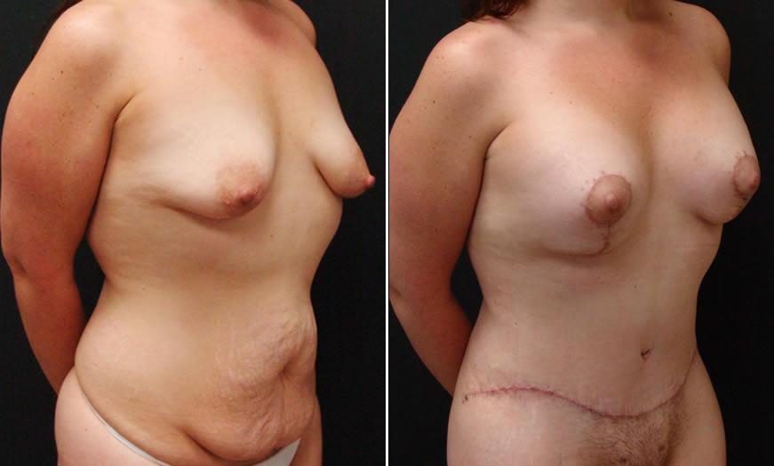 Before & After Breast Augmentation Quarter Right View