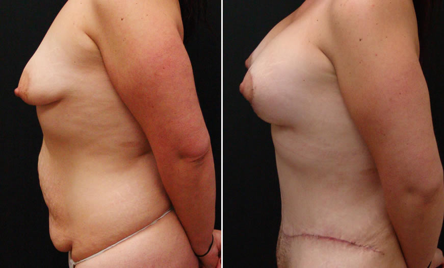 Before & After Breast Augmentation Side Left View