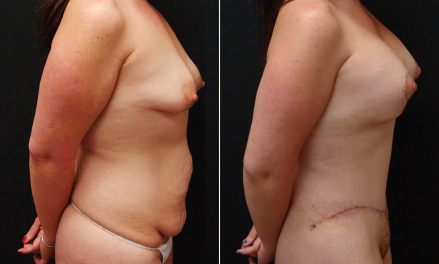 Before & After Breast Augmentation Side Right View