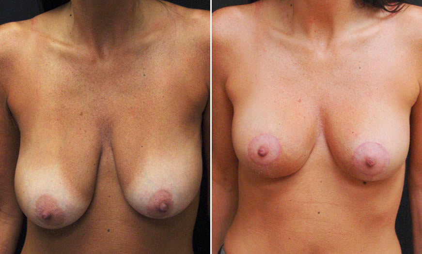 Before & After Breast Lift Front View