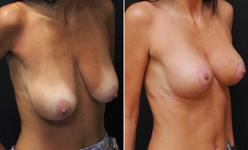 Before & After Breast Lift Quarter Right View