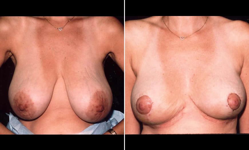 Before & After Breast Lift Front View