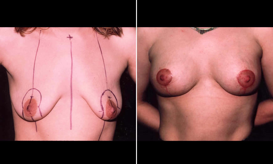 Before & After Breast Lift Front View