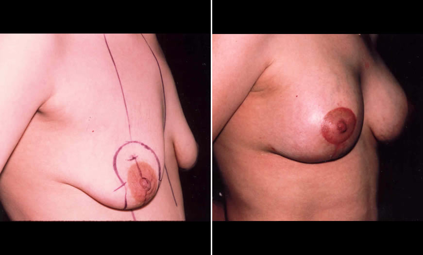 Before & After Breast Lift Side Right View