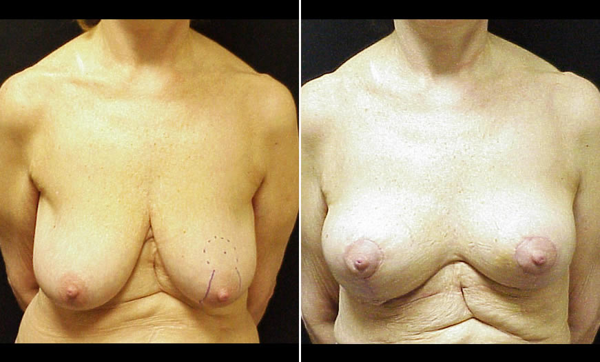 Before & After Breast Lift Front View