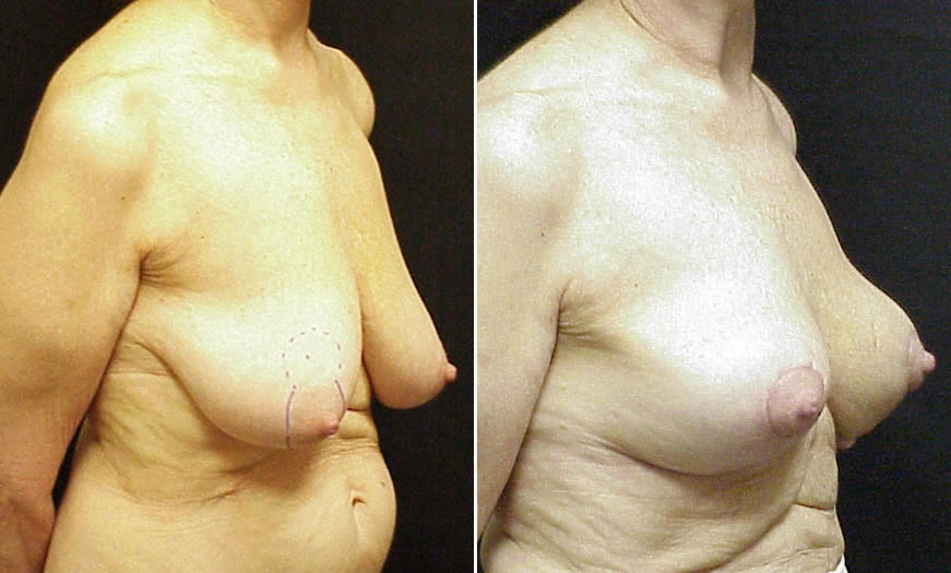 Before & After Breast Lift Quarter Right View