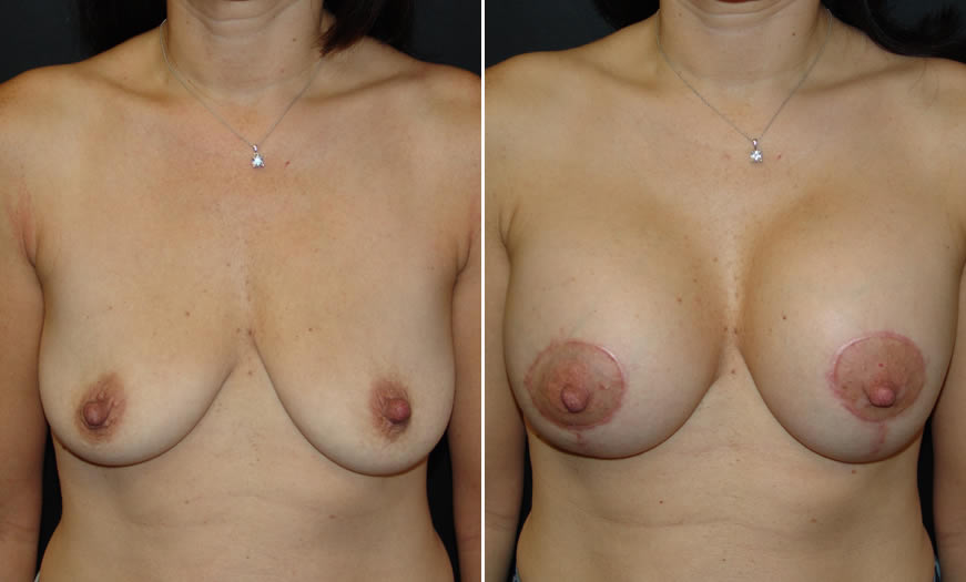 Before & After Breast Lift Front View