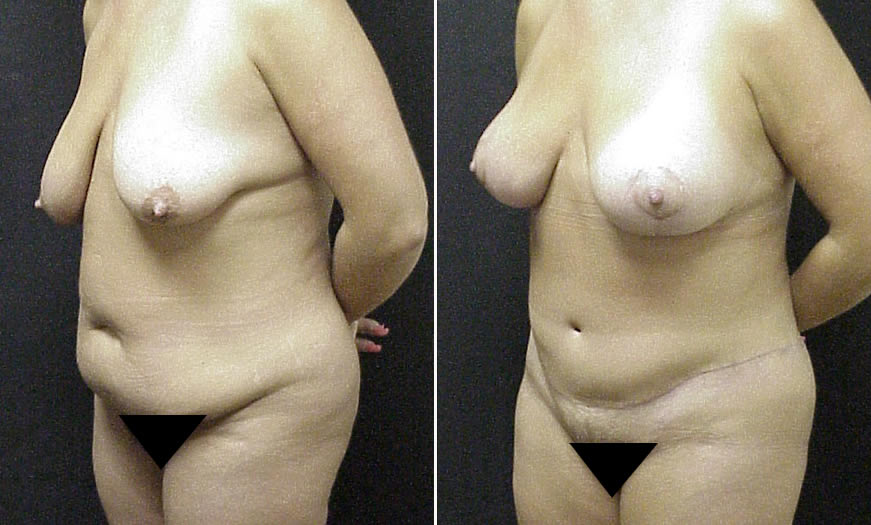 Before & After Breast Lift Quarter Left View