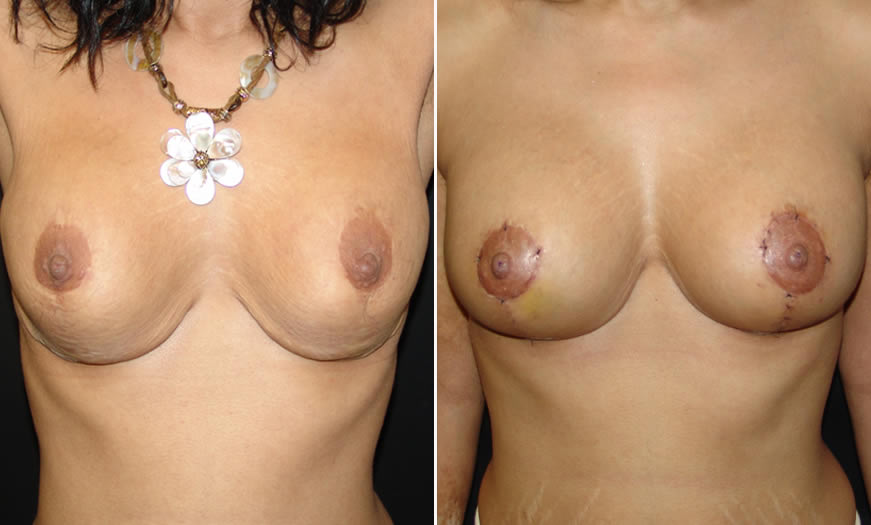 Before & After Breast Lift Front View