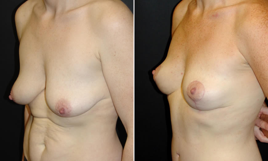 Before & After Breast Lift Quarter Left View