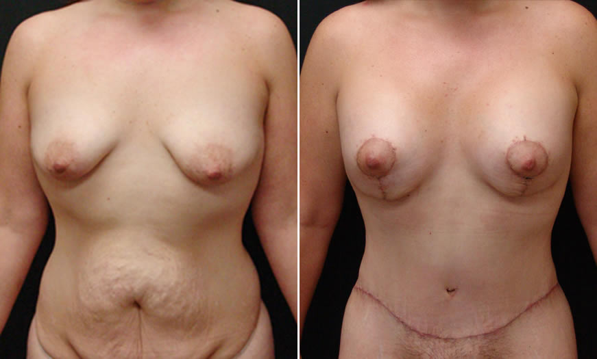 Before & After Breast Lift Front View
