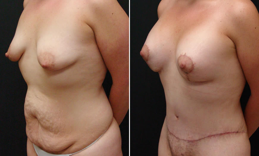 Before & After Breast Lift Quarter Left View