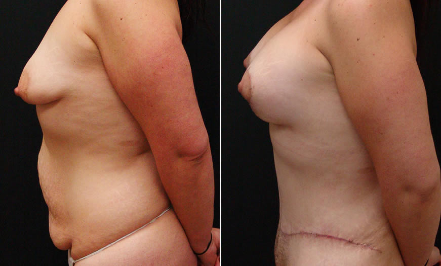 Before & After Breast Lift Side Left View