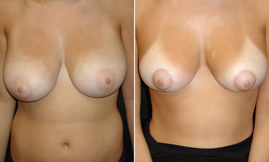 Before & After Breast Reduction Front View