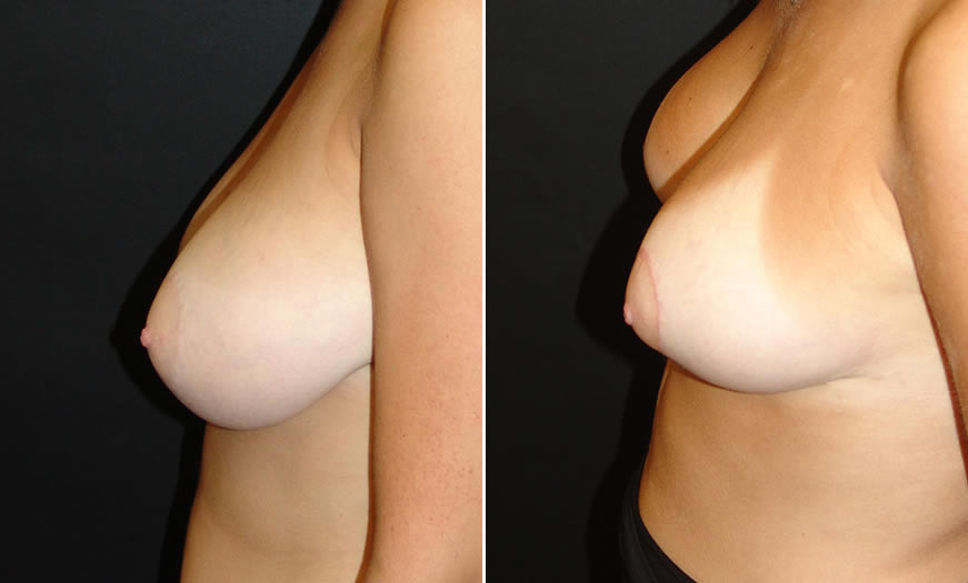 Before & After Breast Reduction Side Left