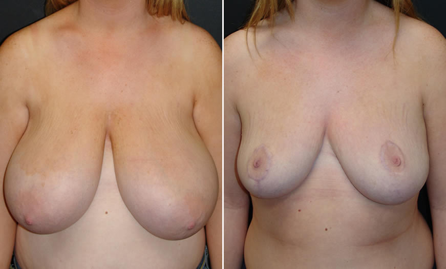 Before & After Breast Reduction Front View